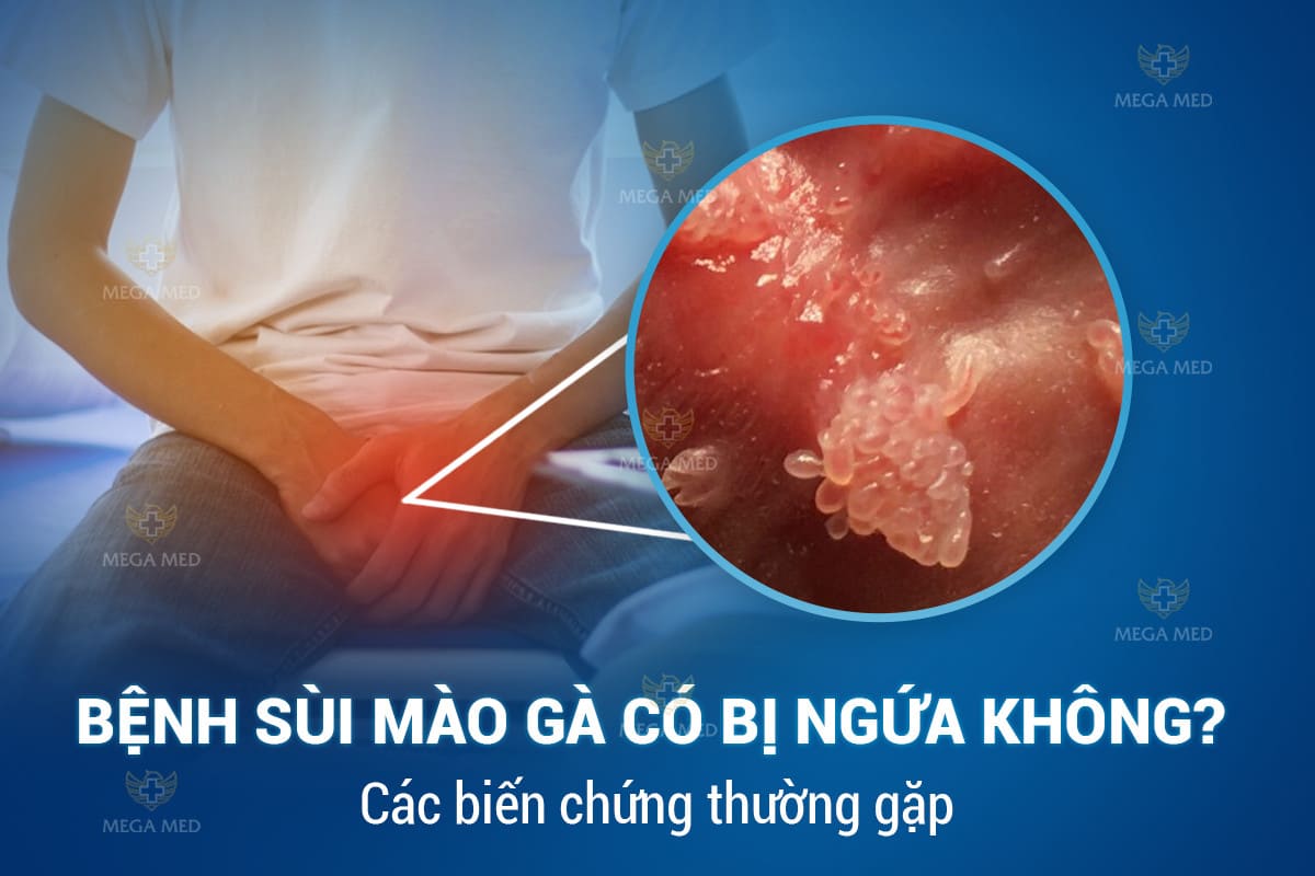 Bệnh sùi mào gà có ngứa không